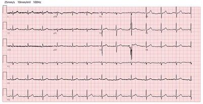 Relative bradycardia presented as a clinical feature of Brucella melitensis infection: A case report